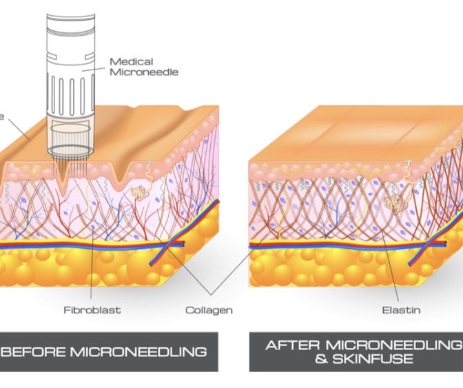 Microneedling Anti Aging Behandlung